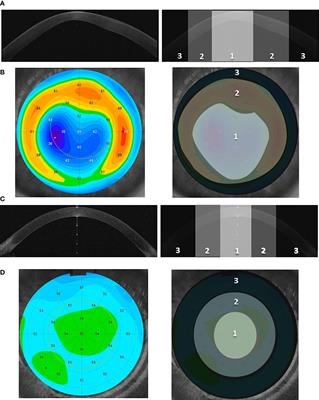 Sequence variants contributing to dysregulated inflammatory responses across keratoconic cone surface in adolescent patients with keratoconus